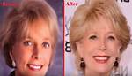 60 Minutes: Did Leslie Stahl Undergo Facelift? American Journalist’s New Look Explored