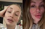 Alyssa Mckay Plastic Surgery Viral on Tiktok: Before and After Photo