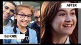 Anna Cathcart Missing Teeth Theory Debunked