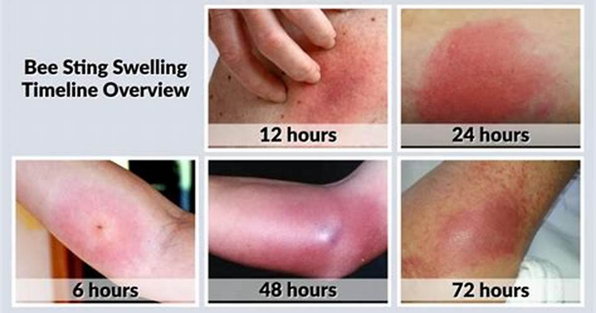Are Bee Stings Supposed to Be Itchy?