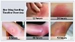 Are Bee Stings Supposed to Be Itchy?