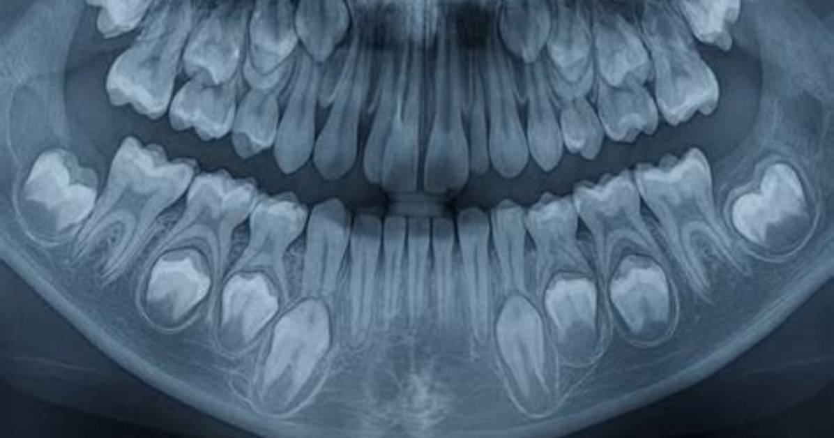 Are Cavities a Big Deal?