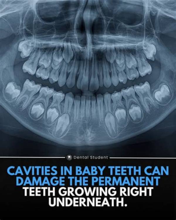 Are Cavities a Big Deal?