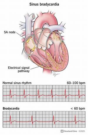 Are Eggs Good for Bradycardia?