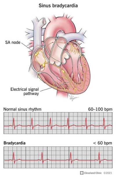 Are Eggs Good for Bradycardia?