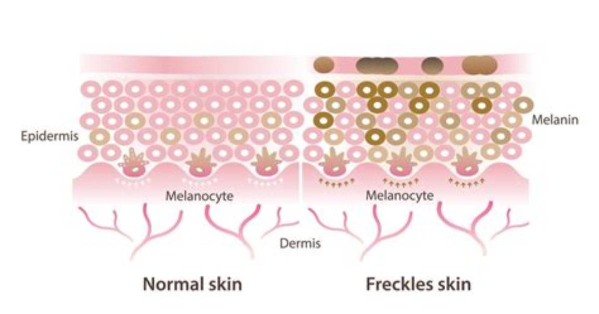 Are Freckles Melanin?