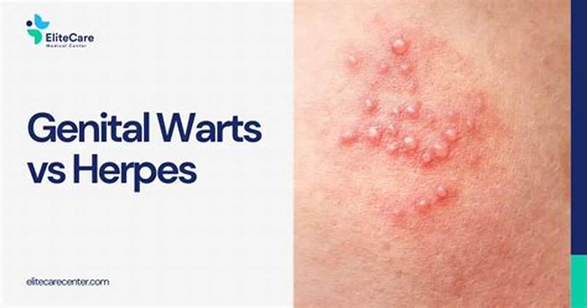Are Genital Warts Herpes?
