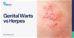 Are Genital Warts Herpes?