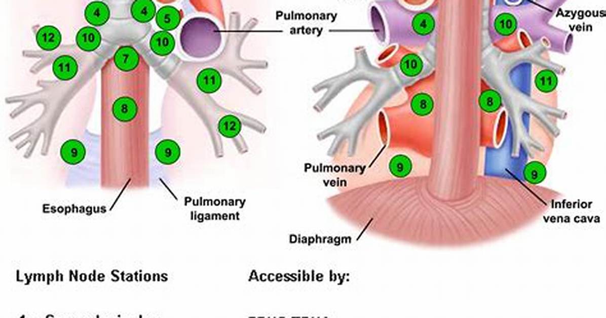 Are Mediastinal Lymph Nodes Always Cancerous?