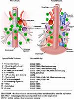 Are Mediastinal Lymph Nodes Always Cancerous?