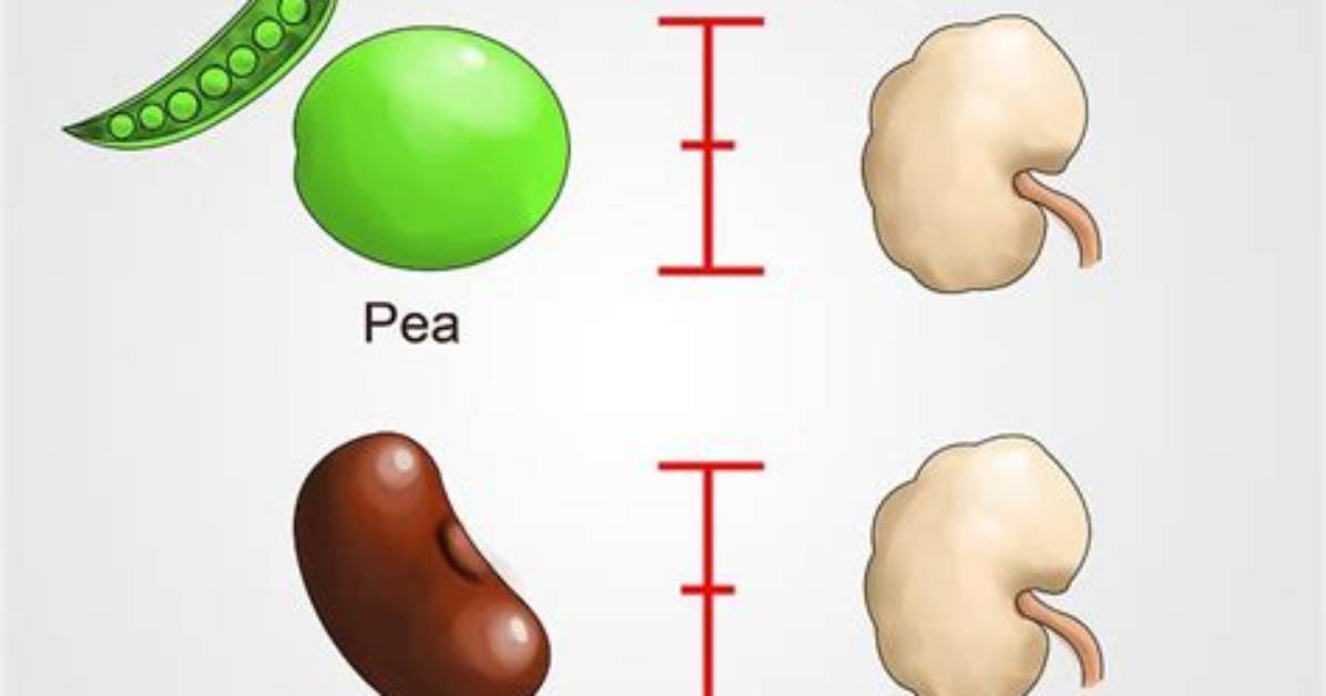 Are Normal Lymph Nodes Pea-Sized?