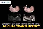 Are Nuchal Translucency Tests Accurate?