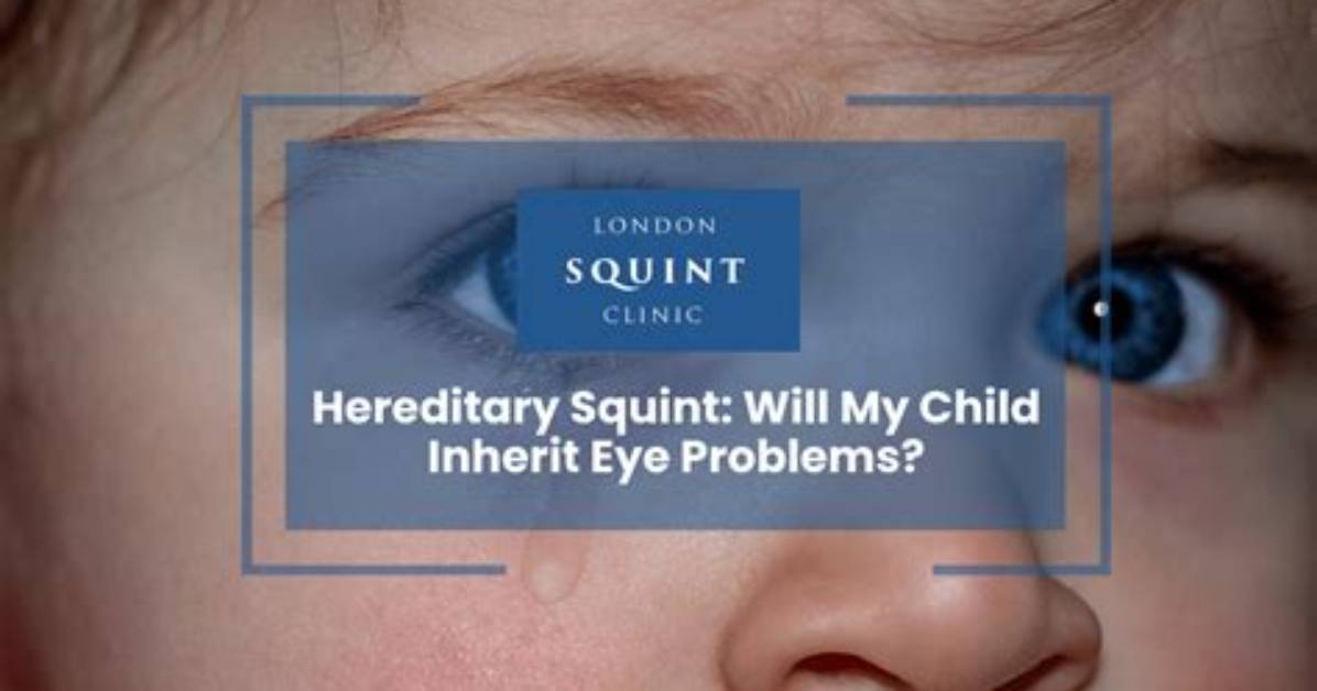 Are Squint Eye Hereditary?