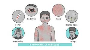 Are the Signs and Symptoms of Measles?