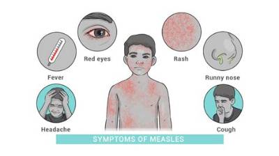 Are the Signs and Symptoms of Measles?