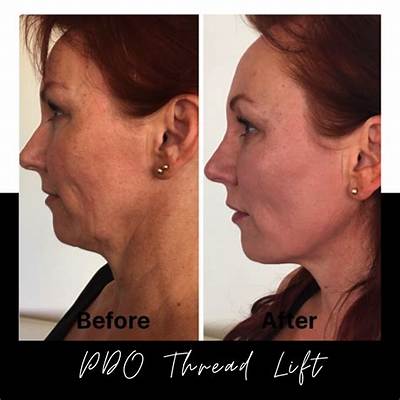 Are Thread Lifts Worth It?