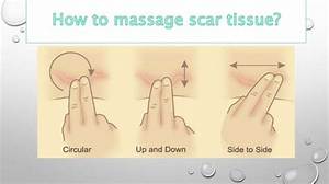 Are You Supposed to Massage Scar Tissue?