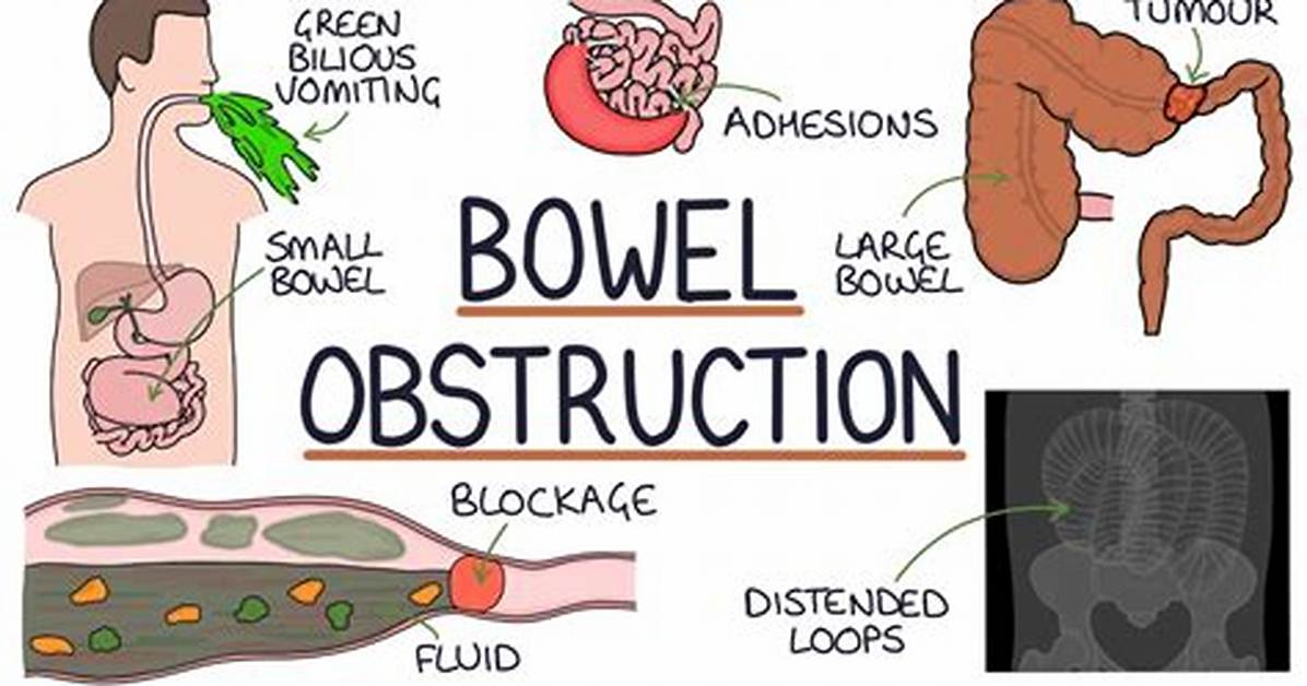At Home Treatment for Partial Bowel Obstruction?