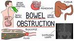 At Home Treatment for Partial Bowel Obstruction?