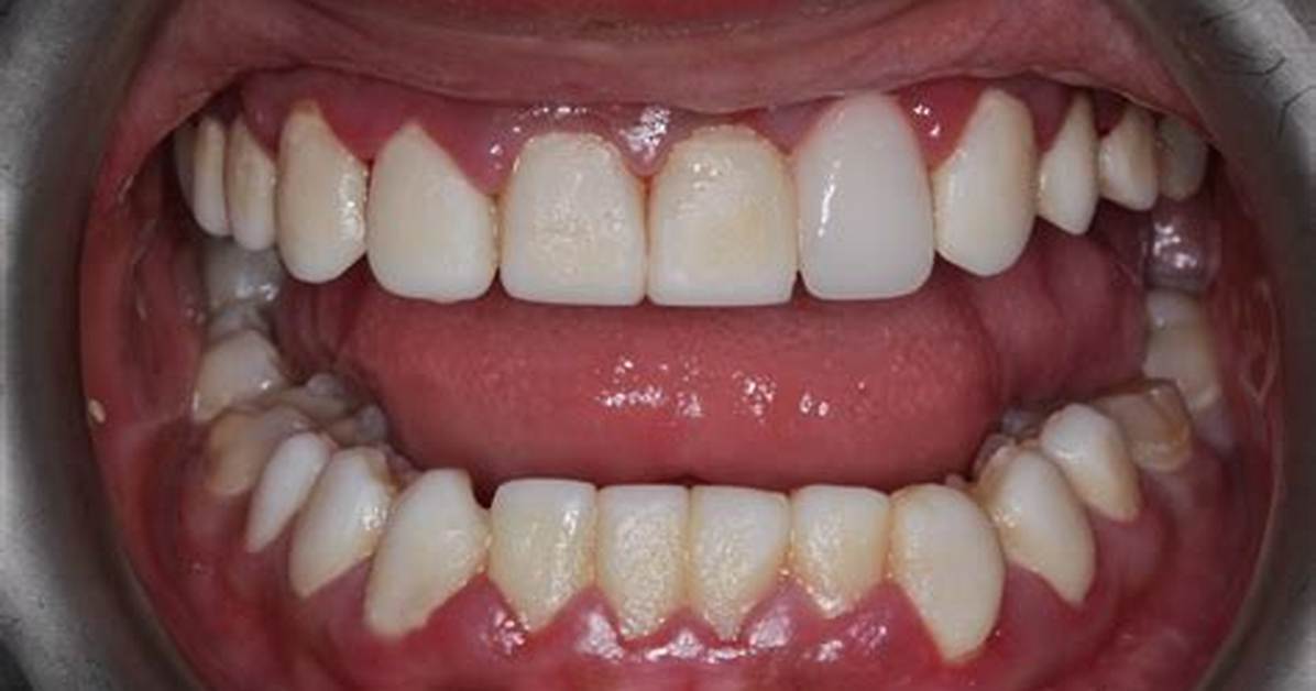 Bad Things About Composite