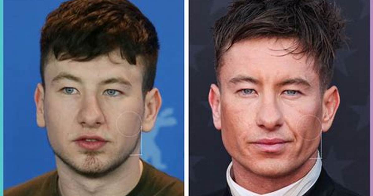 Barry Keoghan Plastic Surgery: Enhancements and Procedures