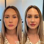 Before and After Lip Fillers
