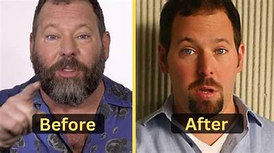 Bert Kreischer Arm Surgery Before and After: Health Update 2023