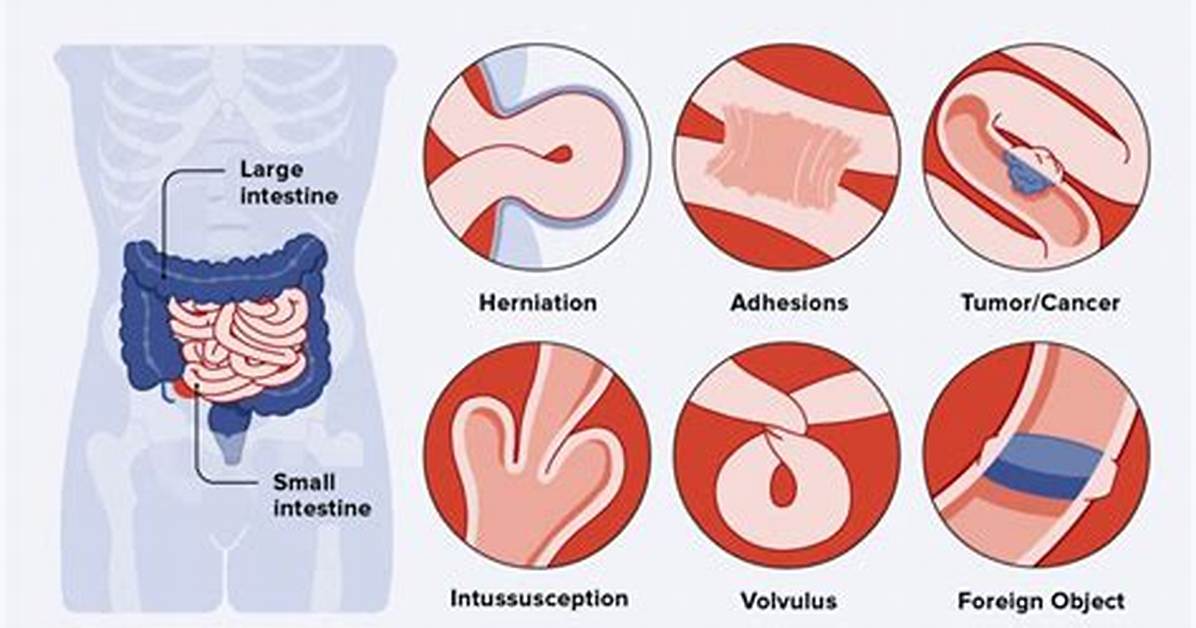 Can a Bowel Obstruction Clear on Its Own?