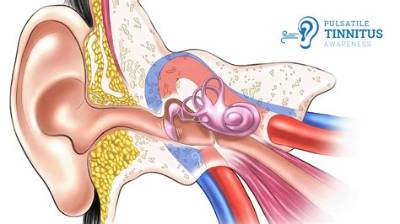 Can a Brain Tumour Cause Pulsatile Tinnitus?