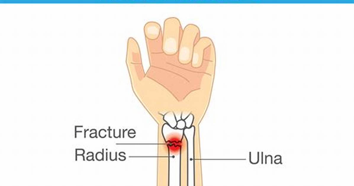 Can a Broken Wrist Heal Without a Cast?