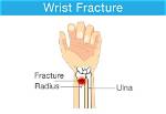 Can a Broken Wrist Heal Without a Cast?