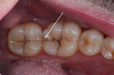 Can a Cracked Tooth Lead to Infection?