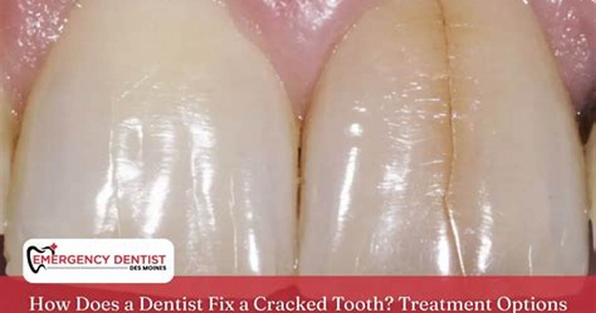 Can a Dentist Pull a Cracked Tooth?
