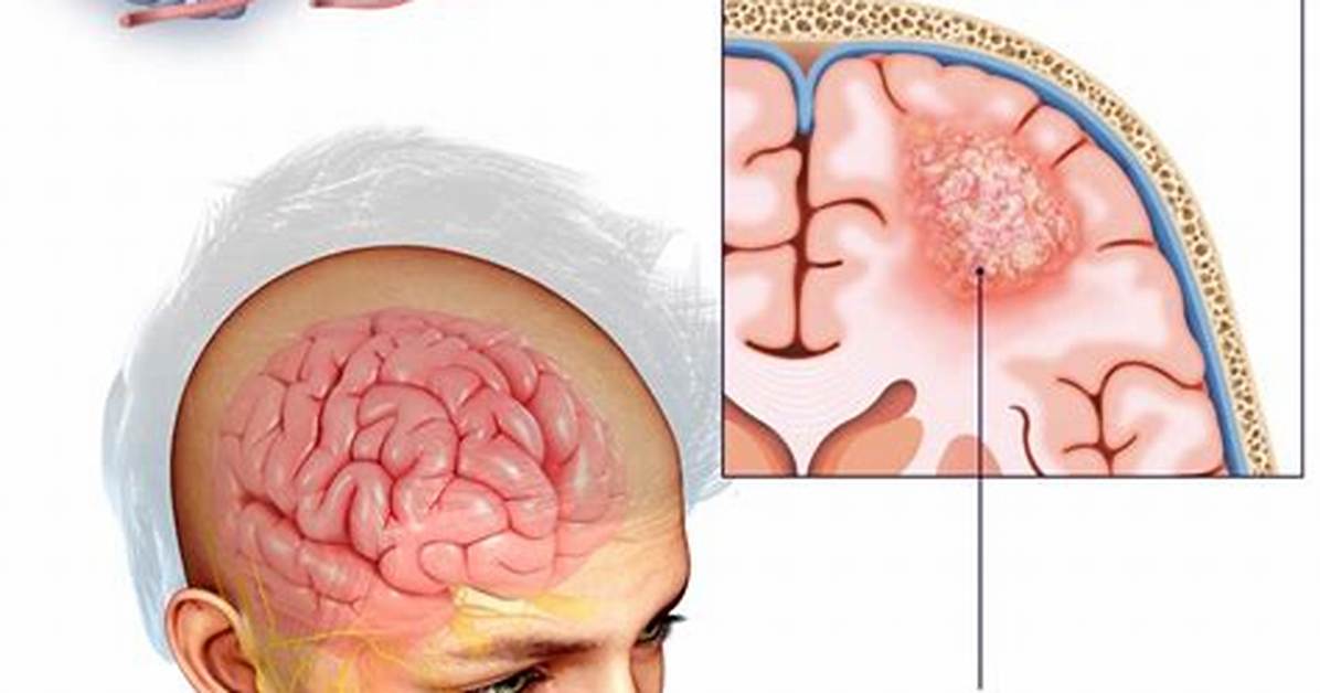 Can a Tumor Burst?