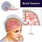 Can a Tumor Burst?