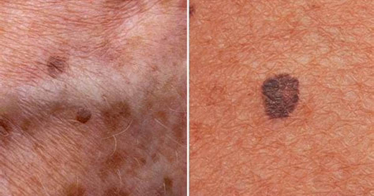 Can Age Spots Turn into Cancer?