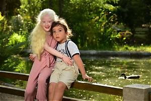 Can Albinos Go to the Beach?