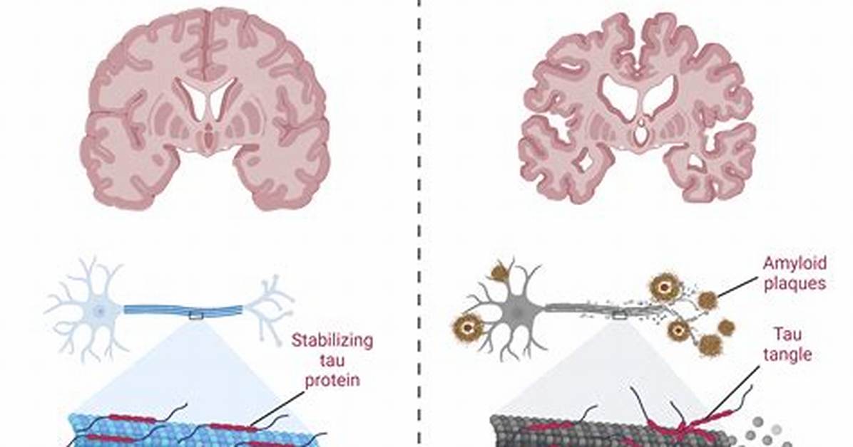 Can Alzheimer's Suddenly Get Worse?
