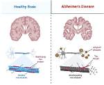 Can Alzheimer's Suddenly Get Worse?