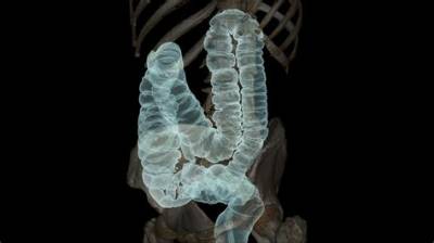 Can an Abdominal Ct Scan Detect Colon Polyps?