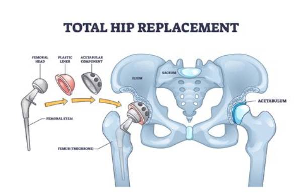 Can an Artificial Hip Pop out?