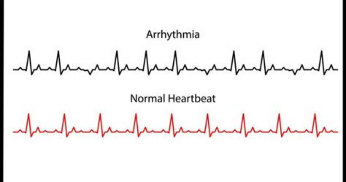 Can B12 Cause Arrhythmia?