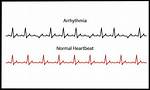 Can B12 Cause Arrhythmia?