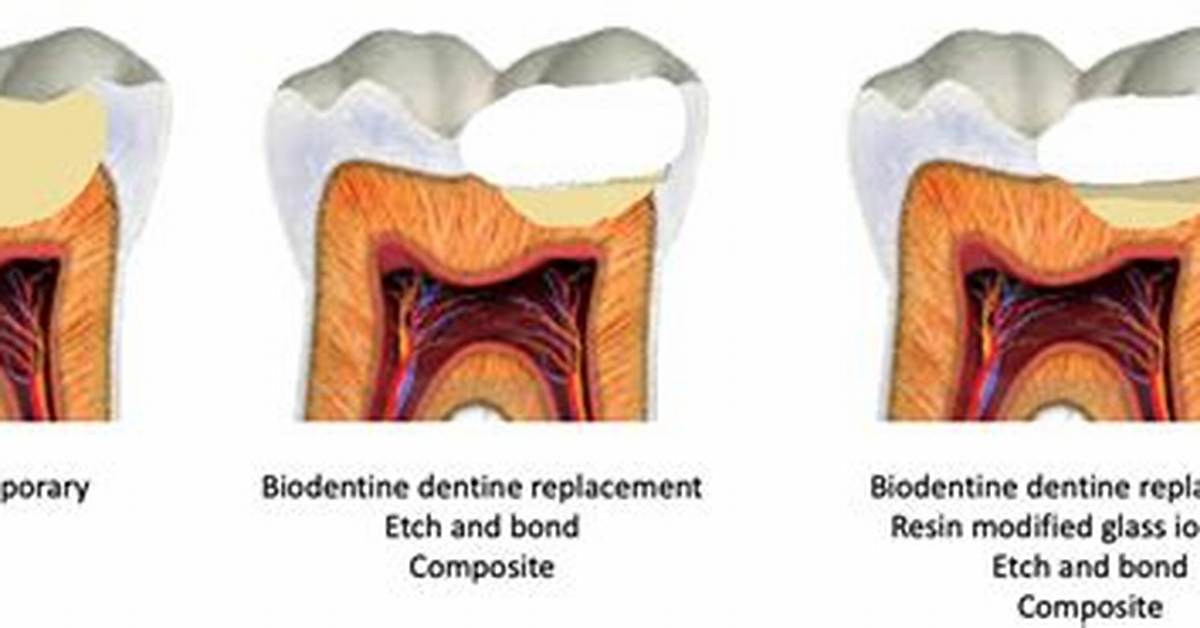 Can Biodentine Be Used for Indirect Pulp Capping?