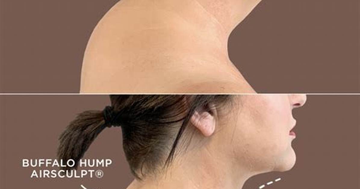 Can Buffalo Hump Go Away?
