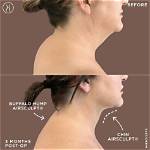 Can Buffalo Hump Go Away?