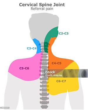 Can C5 C6 Cause Shoulder Pain?