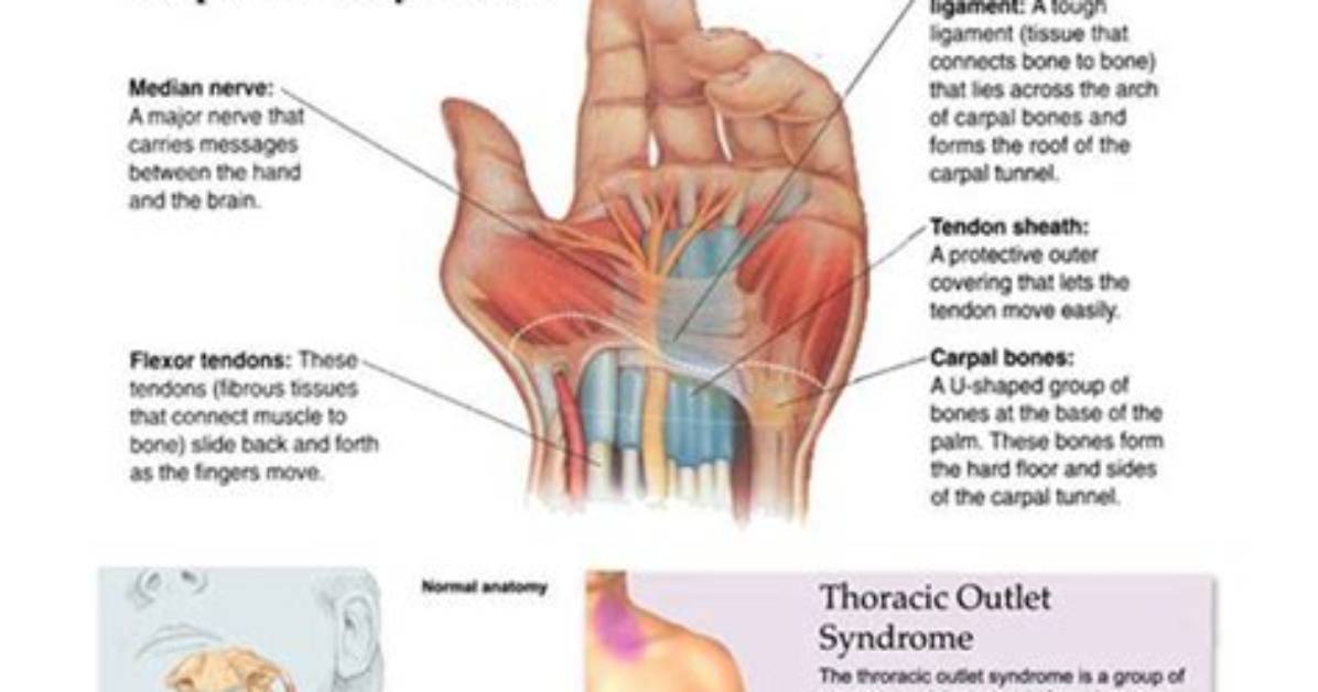 Can Carpal Tunnel Cause Shoulder and Chest Pain?
