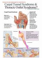 Can Carpal Tunnel Cause Shoulder and Chest Pain?