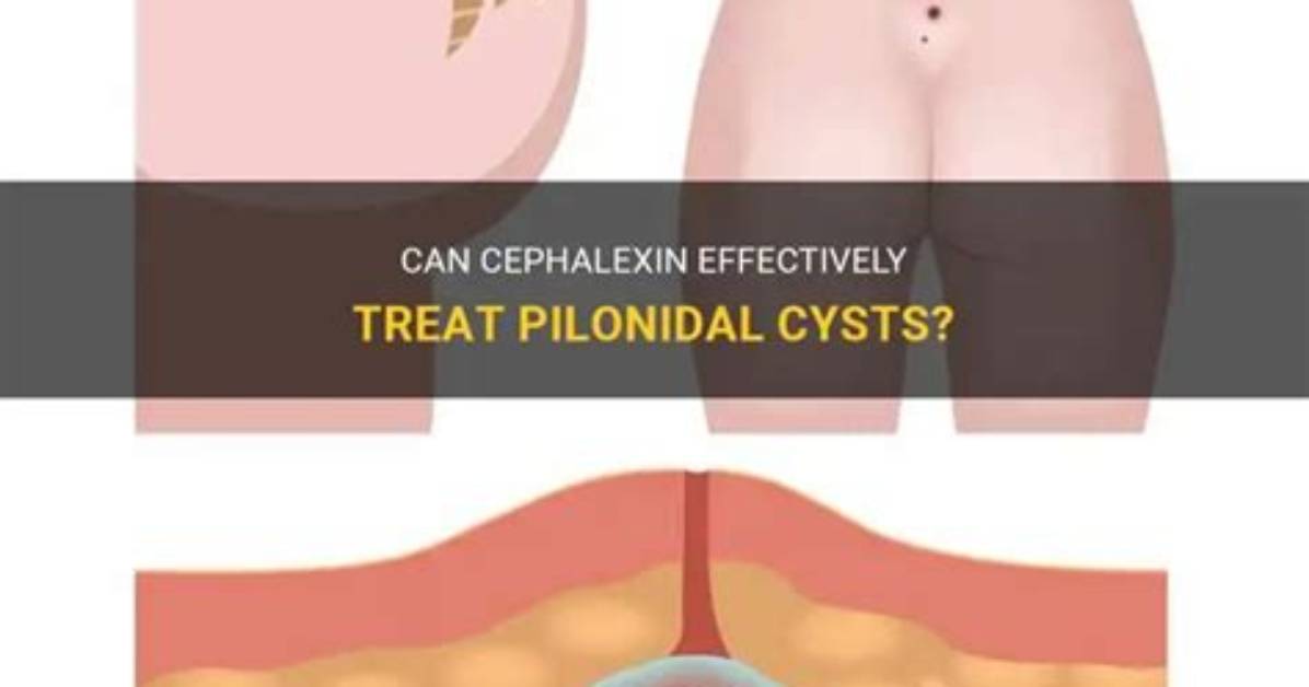 Can Cephalexin Be Used for Cysts?